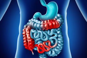 Irritable Bowel Disease